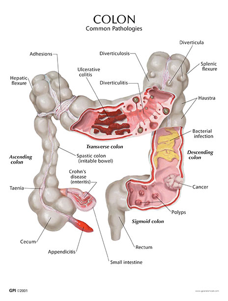 Colon Cancer And Hemorrhoid Treatment Options